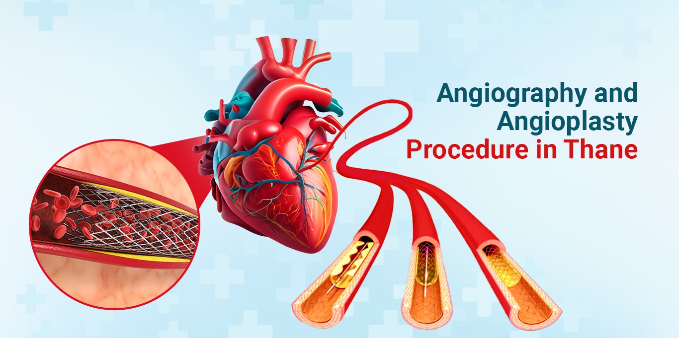 Angiography and Angioplasty Procedure Thane