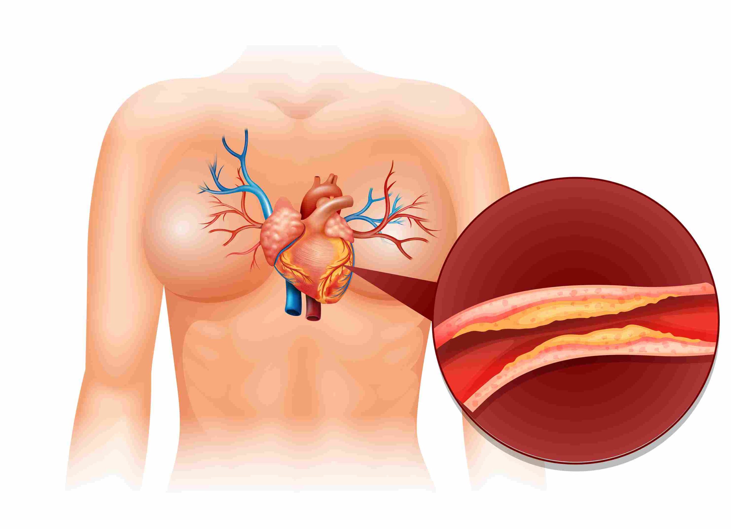 Angiography