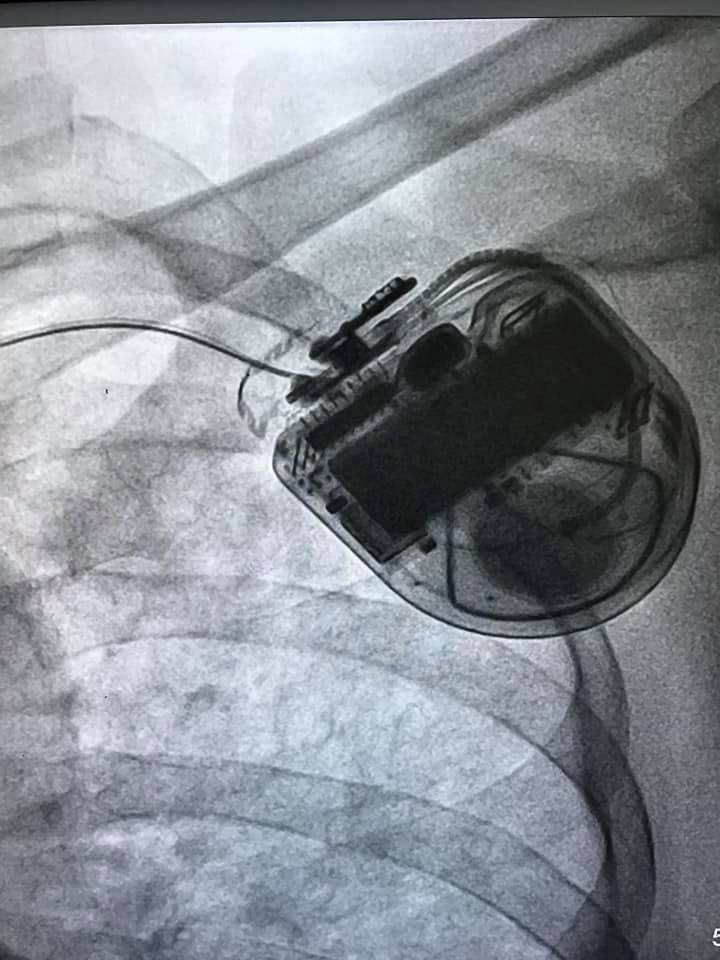 pacemaker implant Surgery in Thane