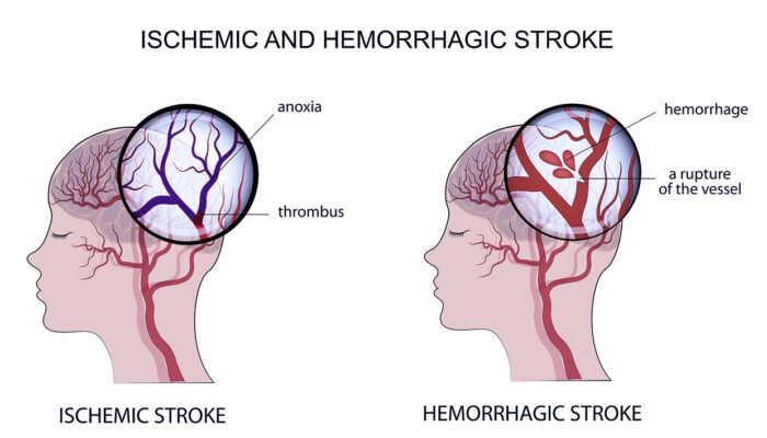 Type of Stroke