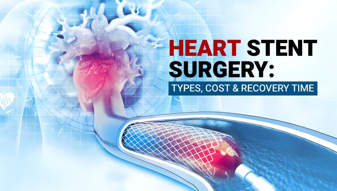 Heart Stent Surgery: Types, Cost & Recovery Time