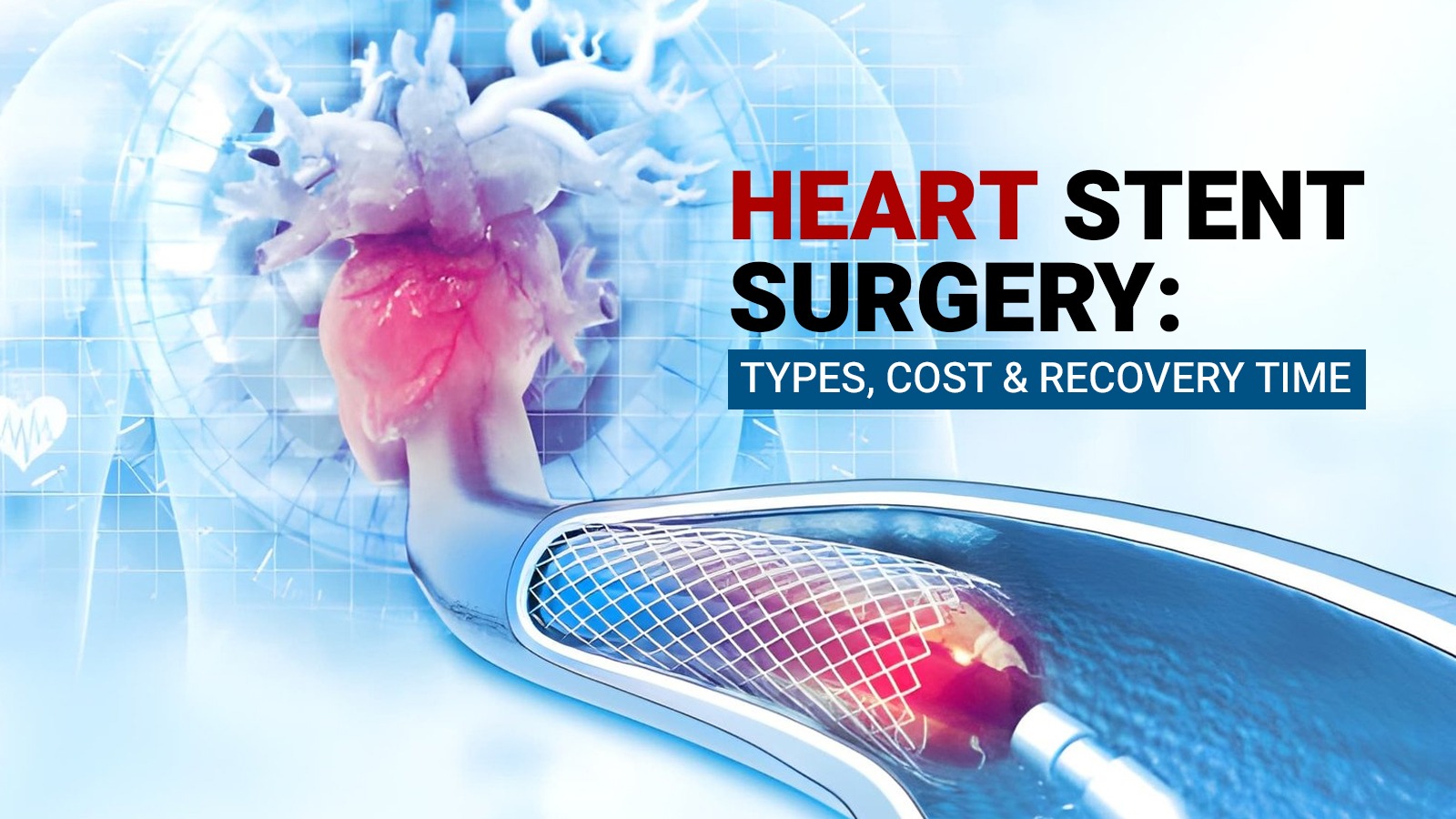 Heart Stent Surgery: Types, Cost & Recovery Time